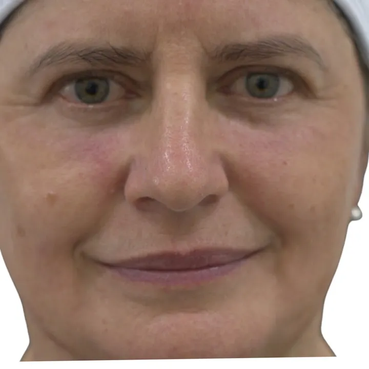 Después del procedimiento de Blefaroplastia sin cirugía