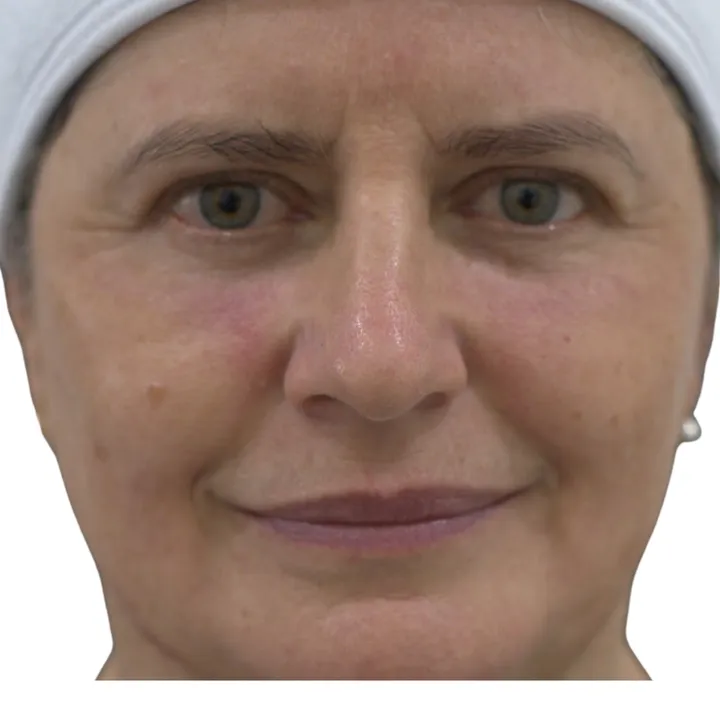 Después del procedimiento de Blefaroplastia sin cirugía