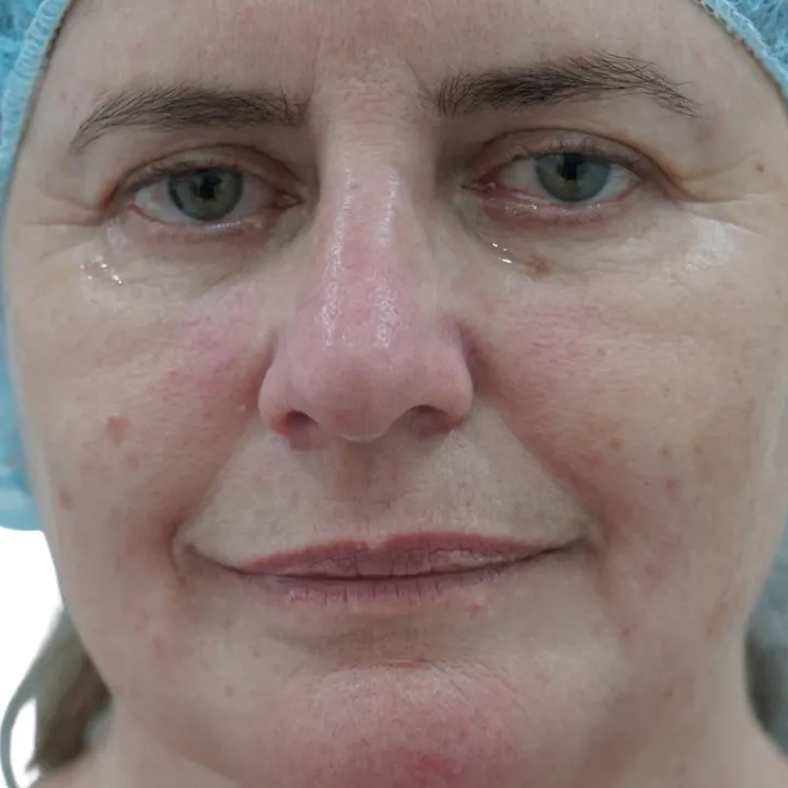 Antes del procedimiento de Blefaroplastia sin cirugía