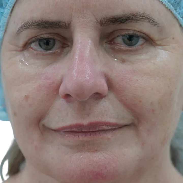 Antes del procedimiento de Blefaroplastia sin cirugía