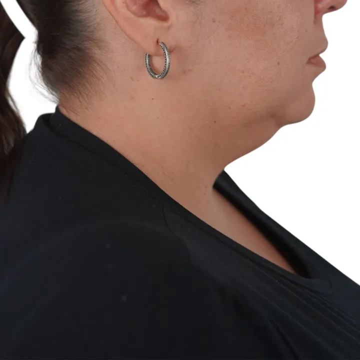 Antes del procedimiento de Deep Neck Lift