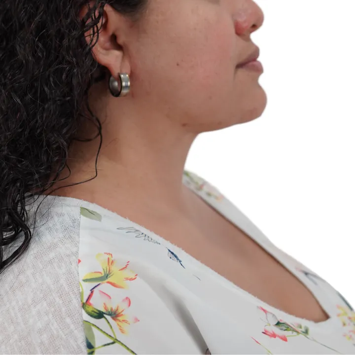 Después del procedimiento de Deep Neck Lift