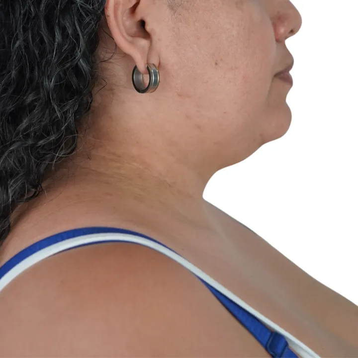 Antes del procedimiento de Deep Neck Lift