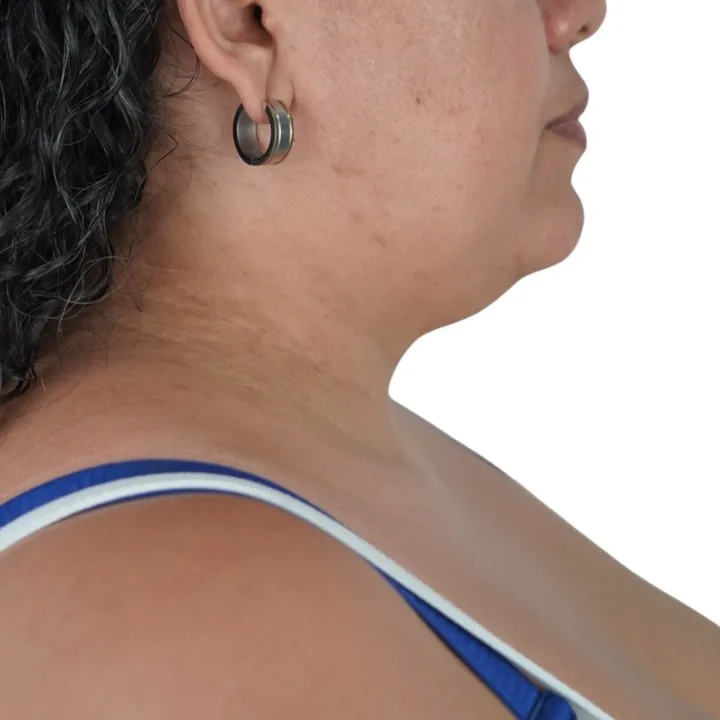 Antes del procedimiento de Deep Neck Lift