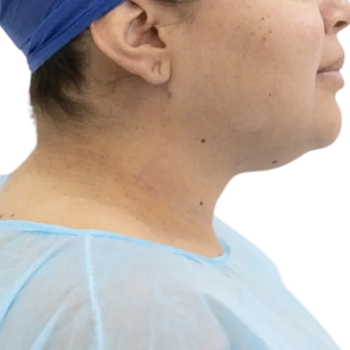 Antes del procedimiento de Lipopapada de cuello