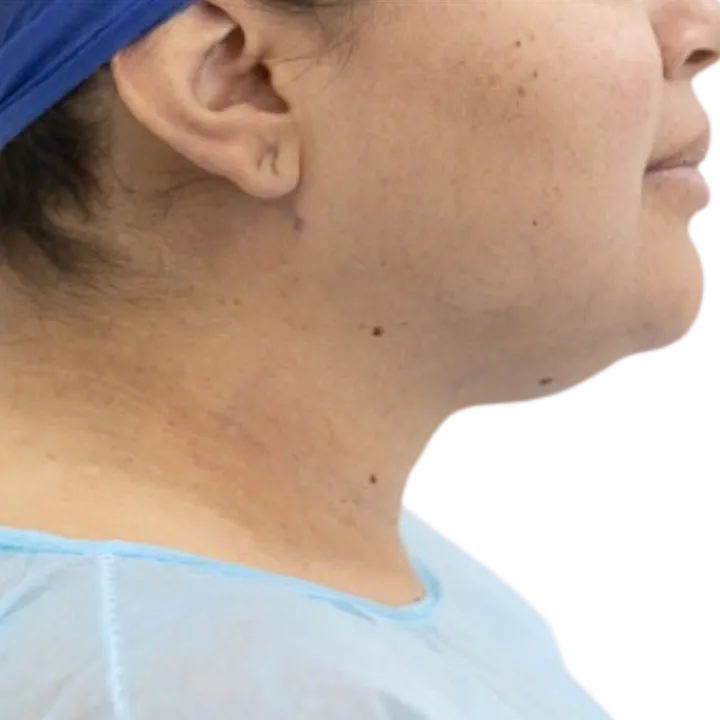 Antes del procedimiento de Lipopapada de cuello