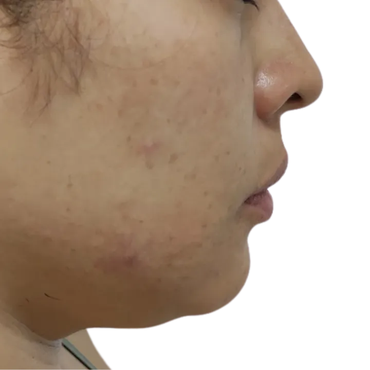 Antes del procedimiento de Lipopapada