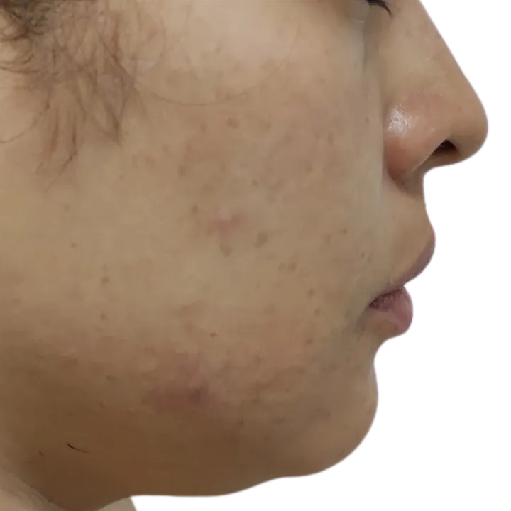 Antes del procedimiento de Lipopapada