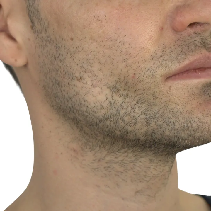 Antes del procedimiento de Implante de ángulo mandibular