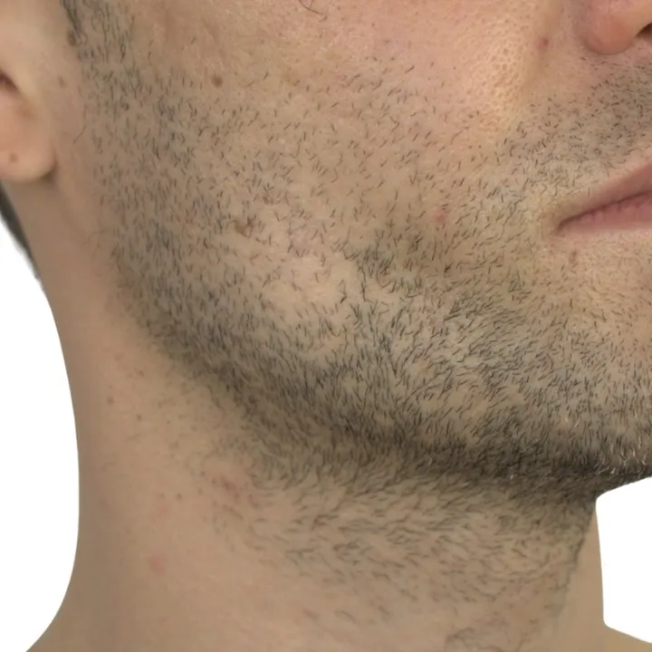 Antes del procedimiento de Implante de ángulo mandibular