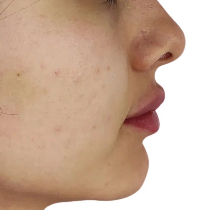 Después del procedimiento de Relleno de labios