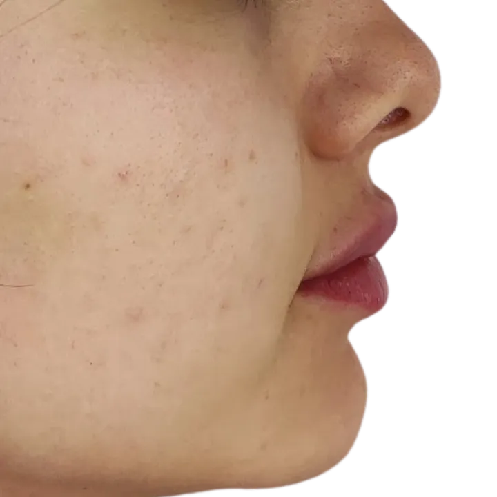 Después del procedimiento de Relleno de labios