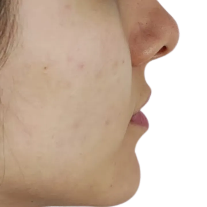 Antes del procedimiento de Relleno de labios