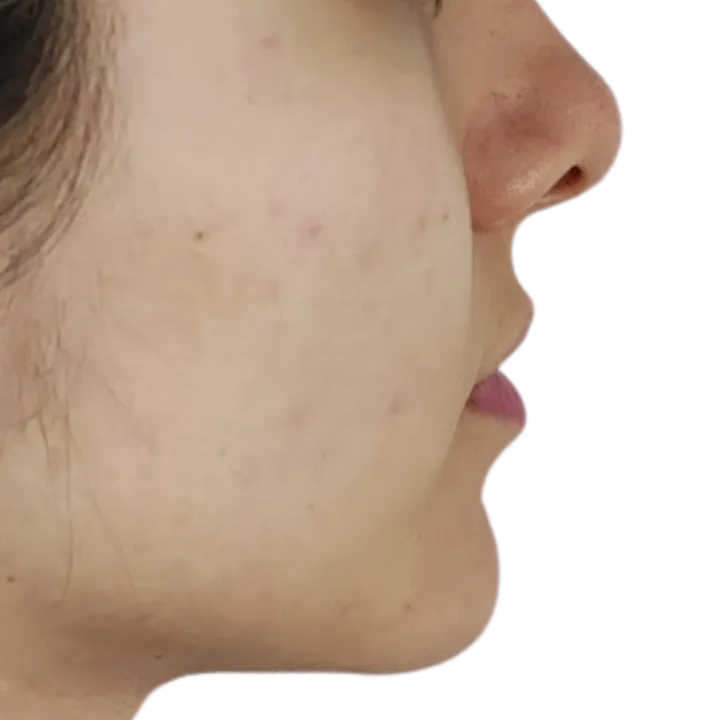 Antes del procedimiento de Relleno de labios